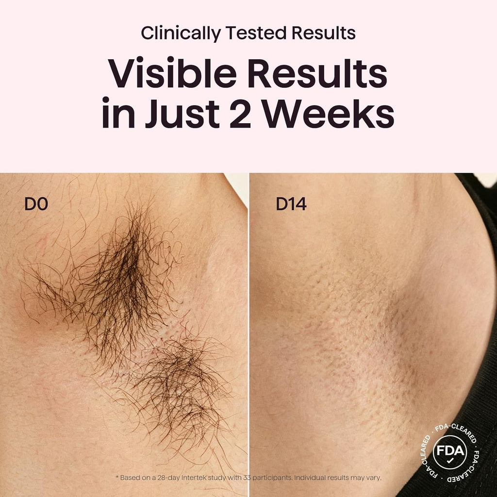 AUTOPDR  Laser Hair Removal,Bare It with Precision Roller for Full Body | Long-Lasting & Painless, 24J Dual-Pulse & Ice Cooling, At-Home Use for Women and Men, Corded