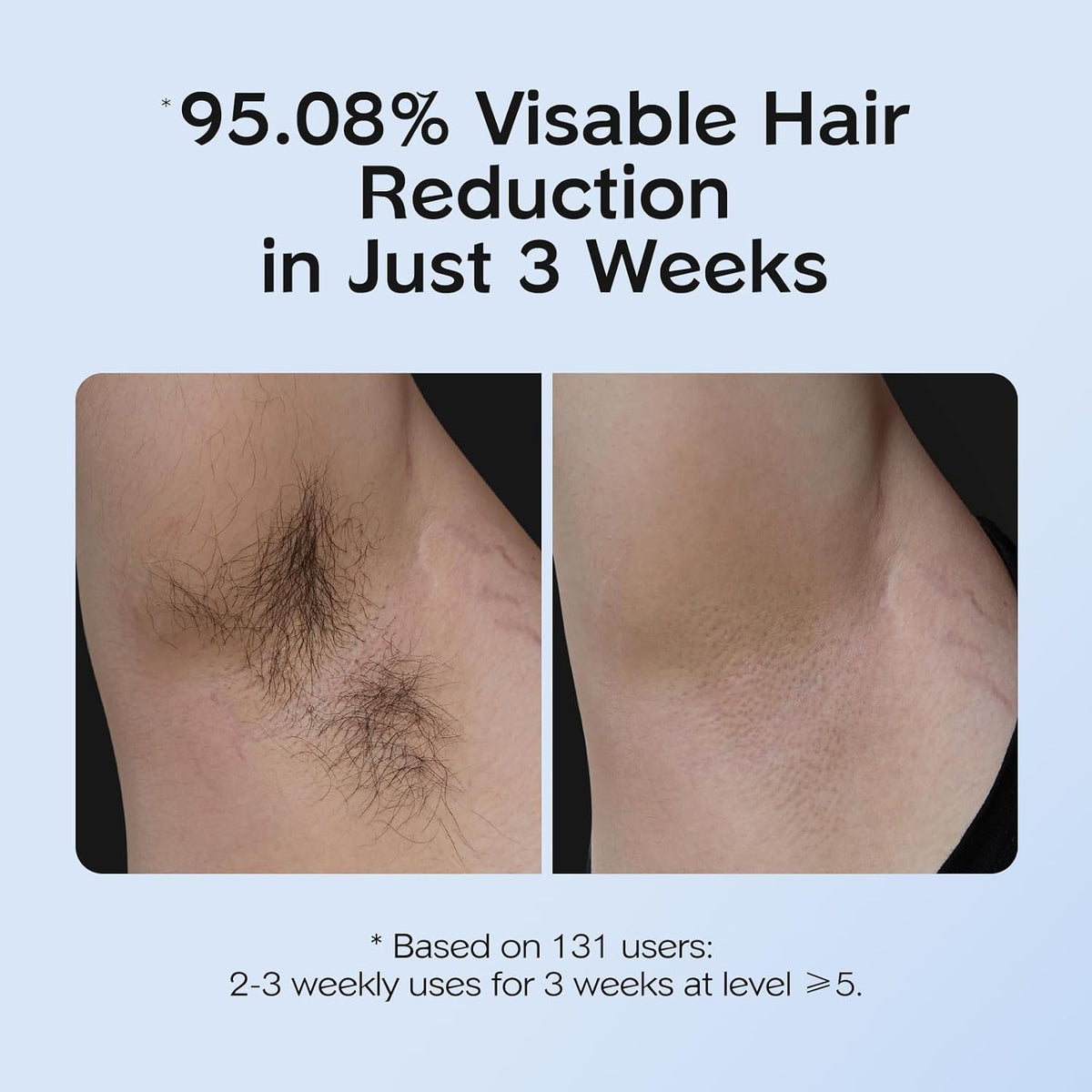 AUTOPDR  Hair Removal with Ice Cooling Care Function for Women,Long-Lasting Results,999,999 Flashes Painless Hair Removal, Hair Removal Device for Armpits Legs Arms Bikini Line